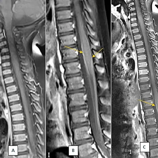 MRI Dorsal Spine With Contrast